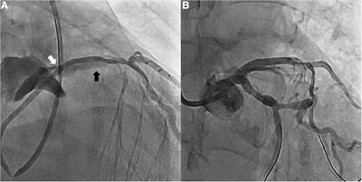Left anterior descending artery dissection with retrograde aortic dissection during percutaneous coronary intervention: a case report
